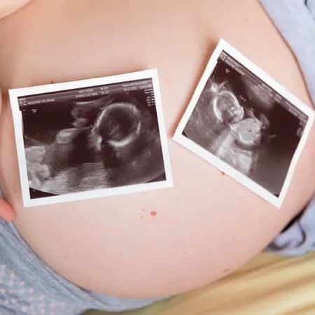 3x Early pregnancy reassurance, viability baby scan package - Now only £170