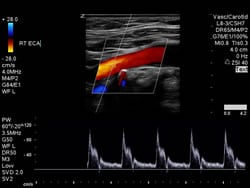 Stroke & Carotid Artery Disease