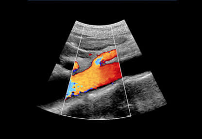 Abdominal Aortic Aneurysm Screening