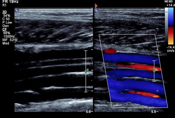 Deep Vein Thrombosis (DVT) In Pregnancy