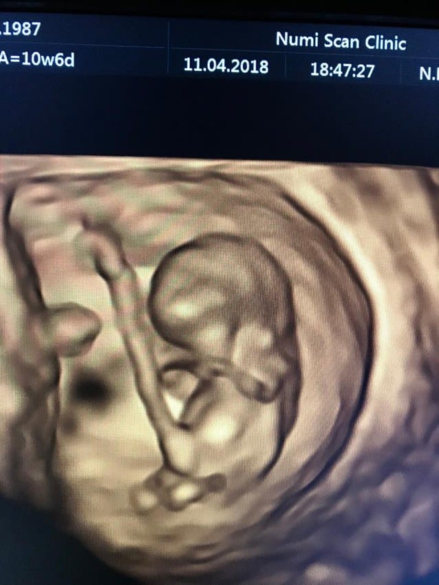 3D Baby Scan