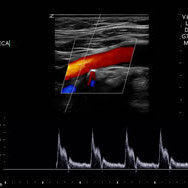 Stroke Screening (Carotid Arteries)