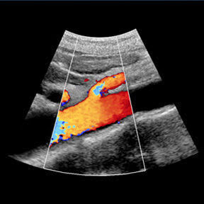 Abdominal Aortic Aneurysm (AAA) Screening