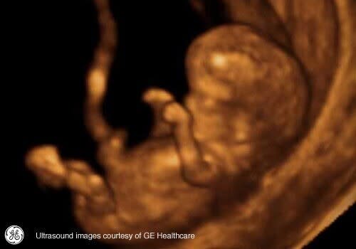 baby scan