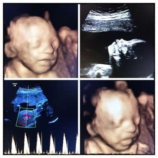 Gender Reveal Scan