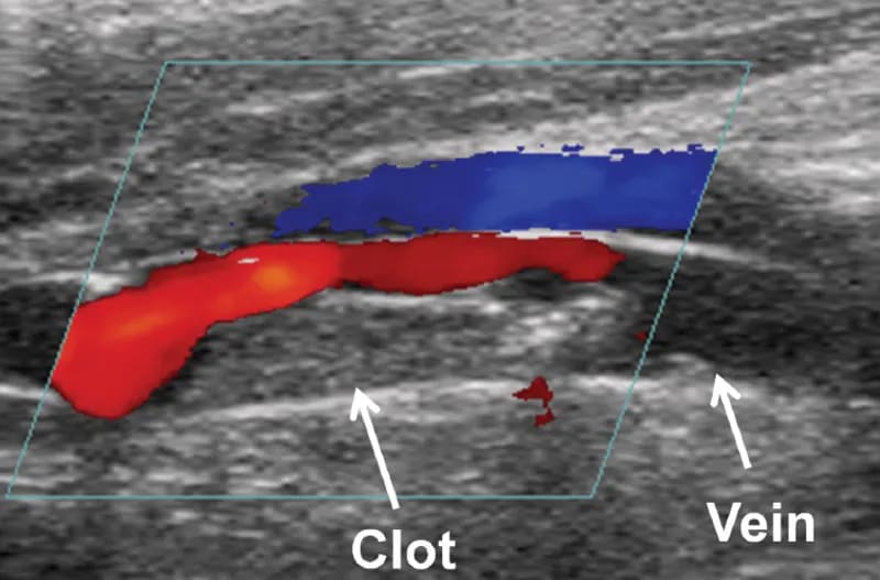 DVT - Deep Vein Thrombosis