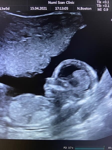 Ultrasound Scans at Numi Scan Stansted