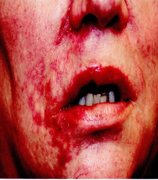 Common signs of vascular occlusion in the lips
