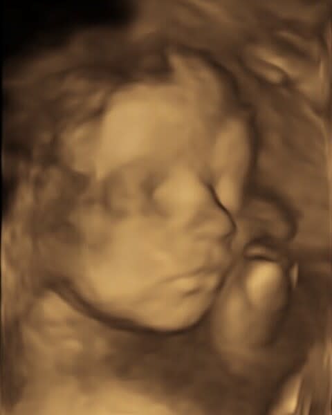 4D Scans (24-32 Weeks)