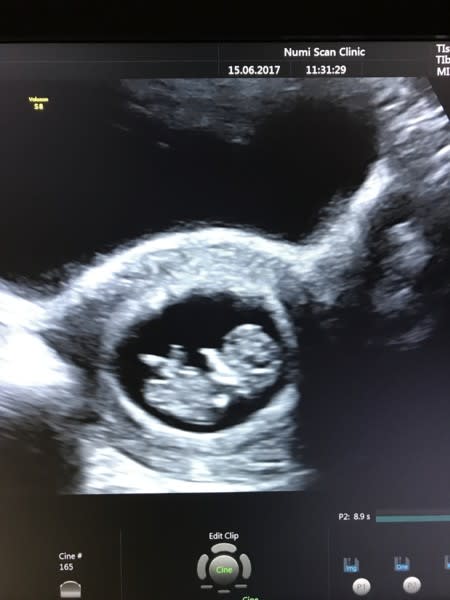 Early Pregnancy Baby Scan