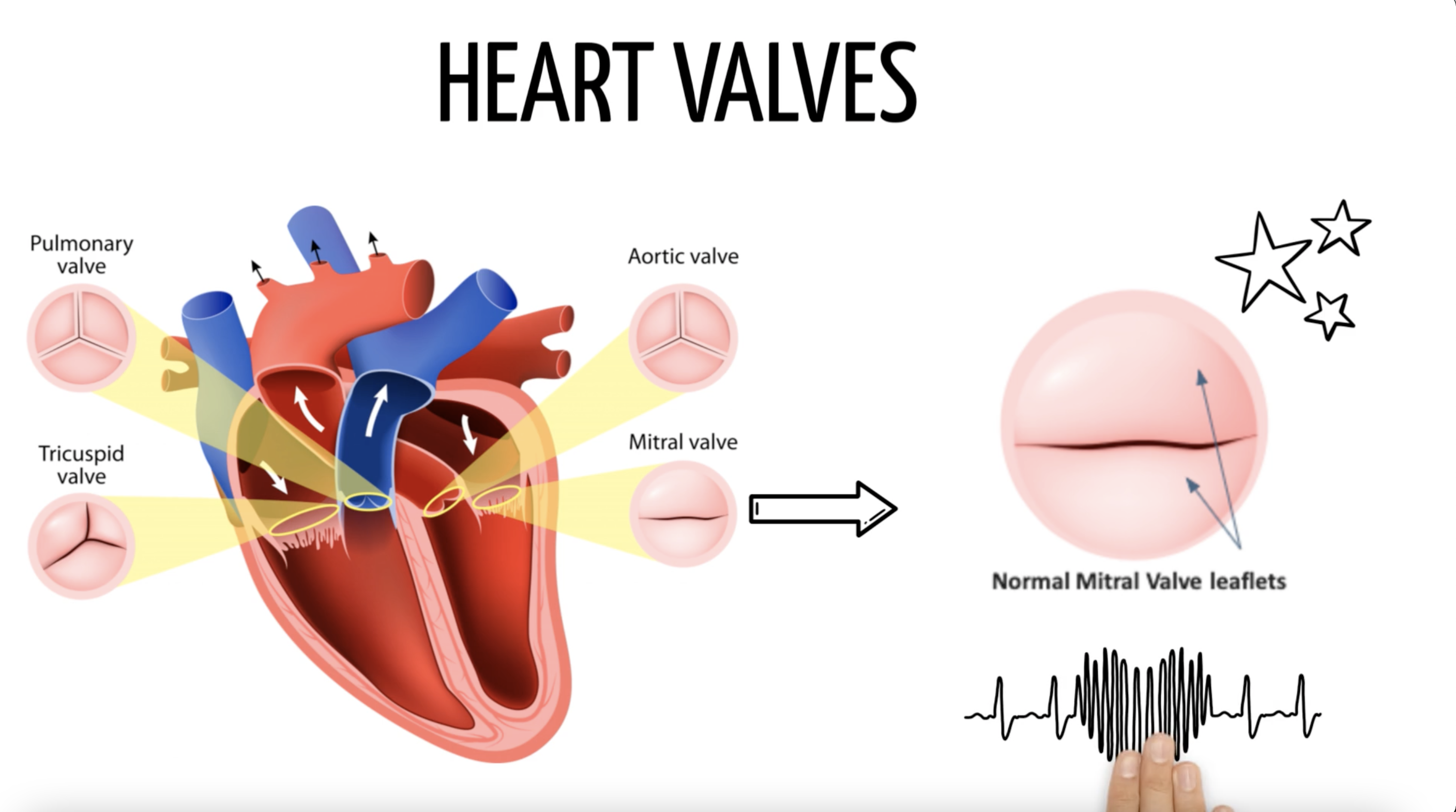 Learn more about Mitral Valve Regurgitation (MR)
