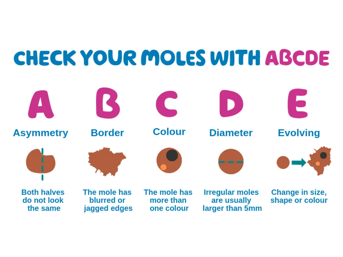 ABCDE mole check