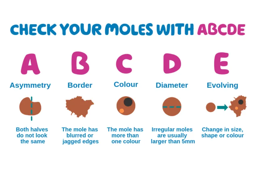 ABCDE mole check