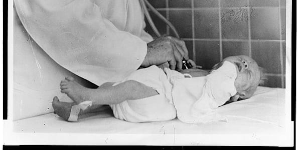 Rheumatic Heart Disease in Pregnancy in the 1960s A strep throat in