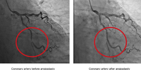 Stented, or Why I've Given Up Living to 100 &nbsp;Coronary artery stent: “a