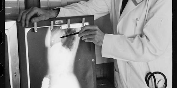 Cerebral Angiography Before the CT Scan 1927 to 1971 Cerebral angiography