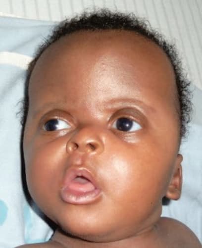 Apert syndrome, a genetic syndrome found by Dr. Mubungu