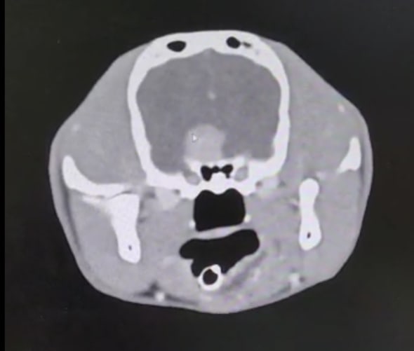 CT Bild (weisse Mitte = Tumor)