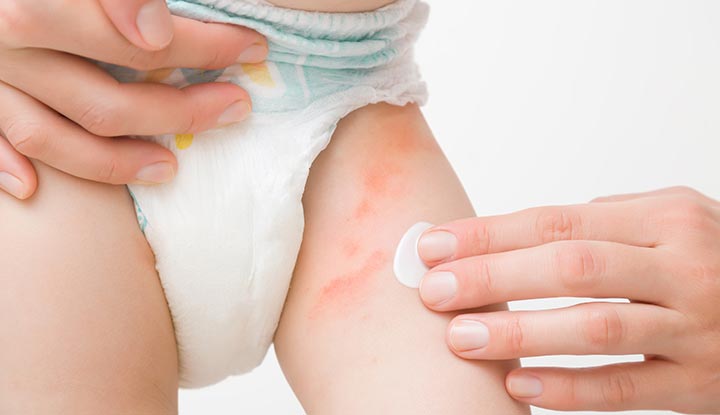 Penyebab Dermatitis Popok Pada Bayi dan Cara Mengatasinya