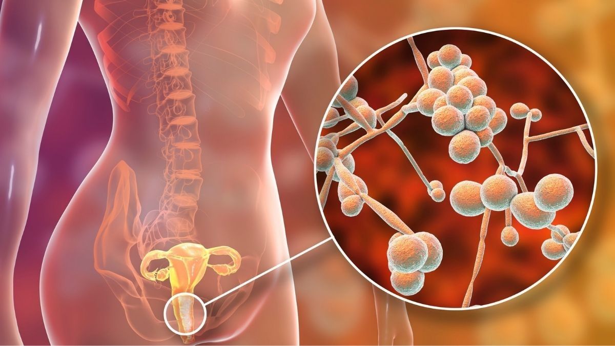Waspada 4 Jenis Infeksi Vagina Saat Menstruasi