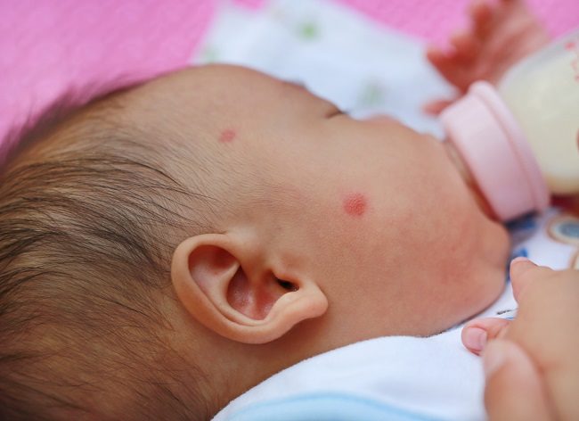 Ciri-ciri Anak Alergi Susu yang Dikonsumsi