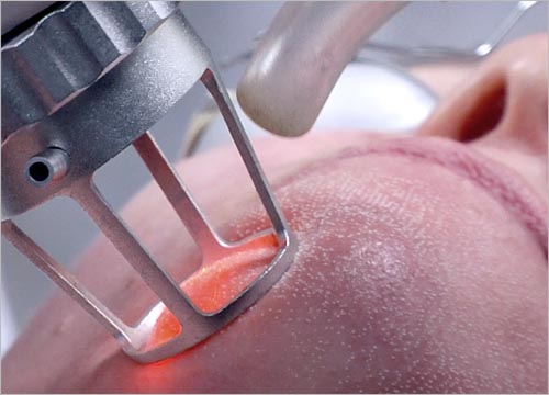 Mengatasi Acne Scar Dengan Laser CO2 Fractional
