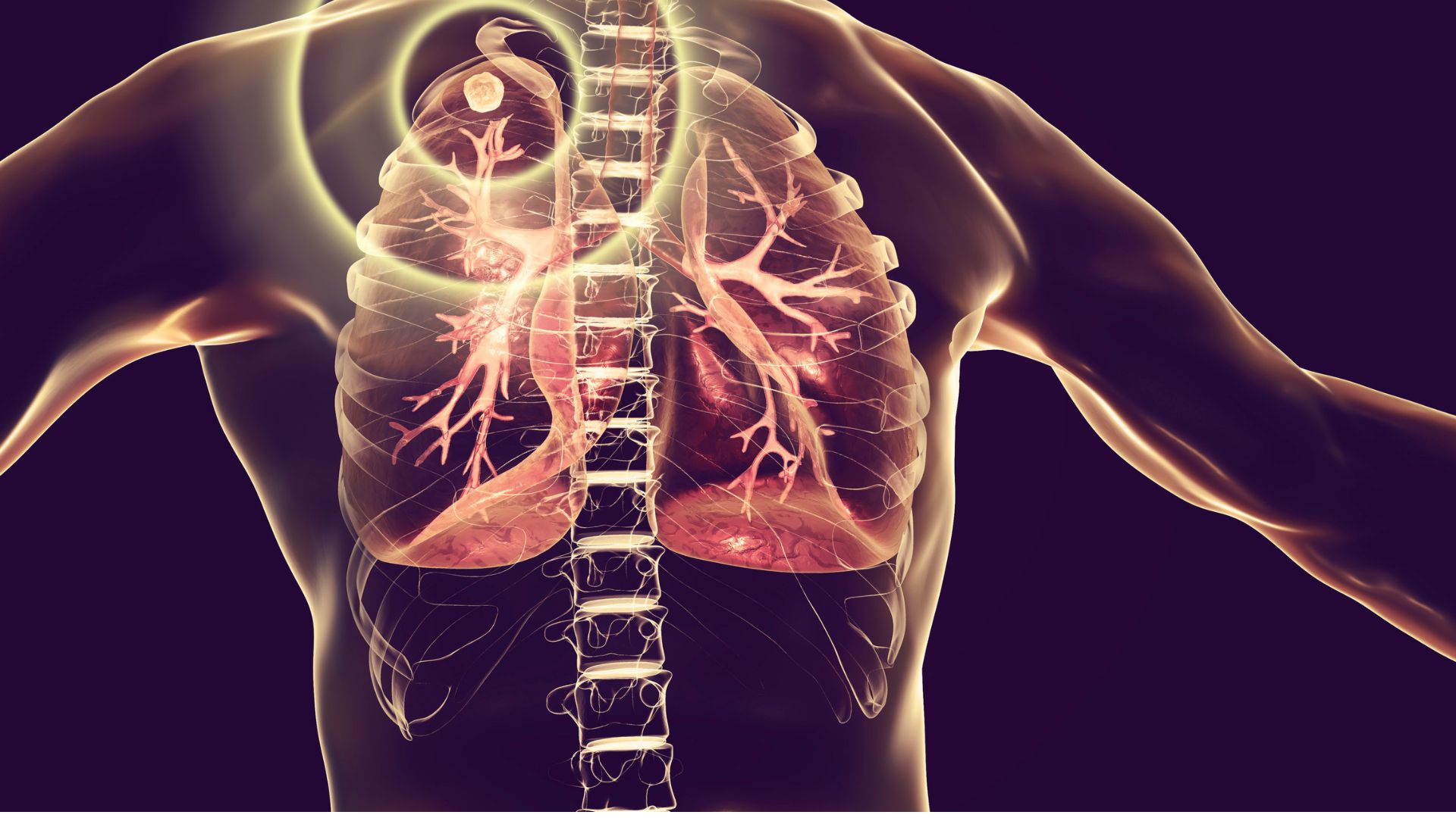 Dukung Pemerintah Mengeliminasi Tuberkulosis 2030, PT. Otsuka Inisiasi Program "Free TBC At Workplaces" 3 Ilustrasi Penyakit Tuberkulosis (TBC) - Science Photo Library