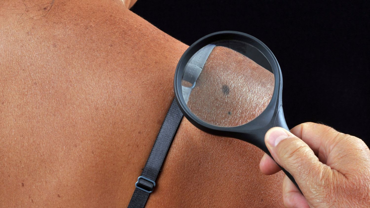 Dépistage dermatologique : l'intelligence artificielle pour pallier la pénurie de médecins