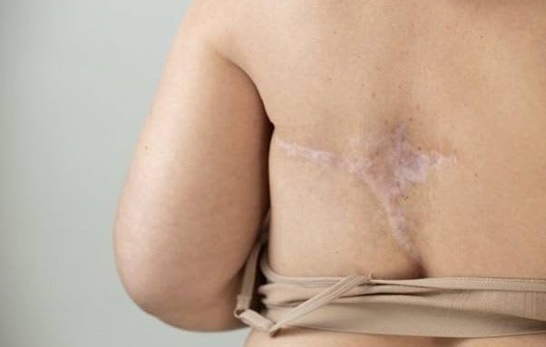 Cancer : le déremboursement du Zoladex suscite l’inquiétude des patients