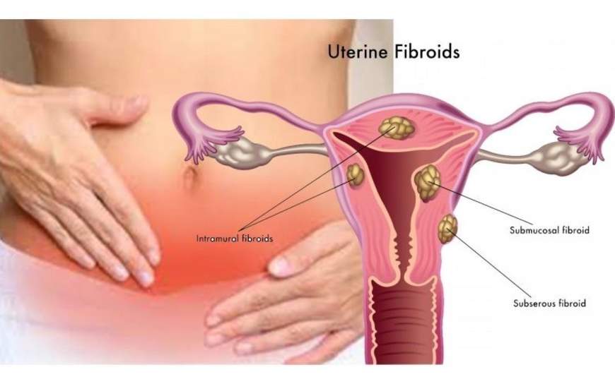 Successfully Treat Fibroids with Acupuncture & Herbs