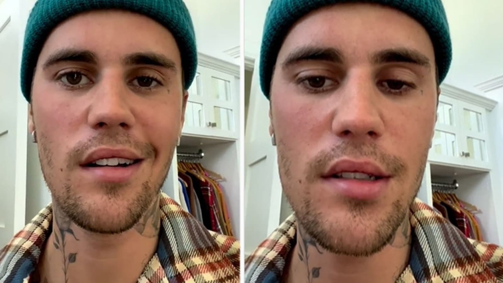 Ramsay Hunt syndrome: the story behind Justin Bieber’s face paralysis