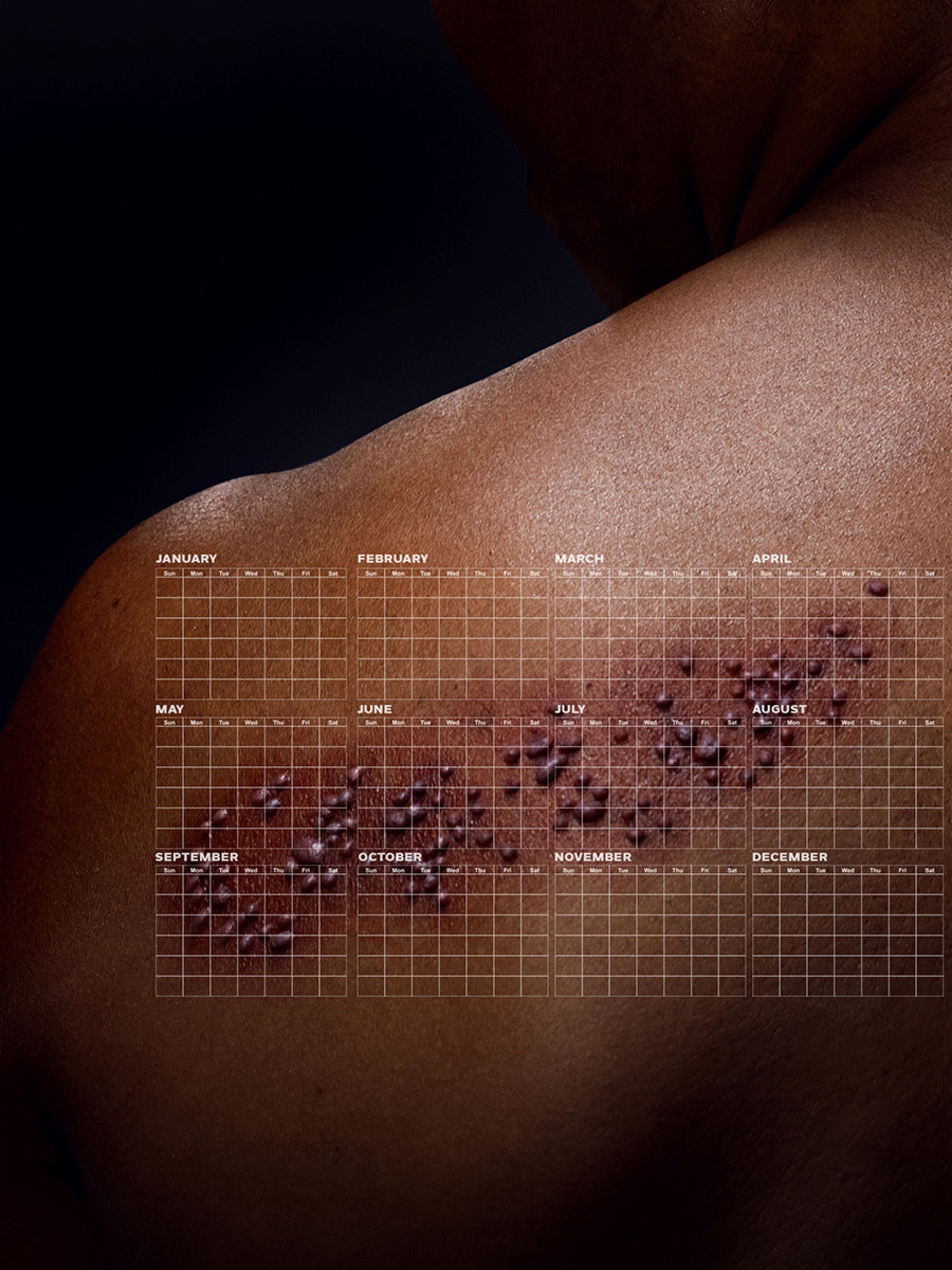 The image shows the back of a person. Superimposed on their skin is a calendar grid covering the entire year. Several of the calendar squares, spanning from May to August, are filled with illustrations of shingles blisters. Below this visual is the text "EVERY SEASON IS SHINGLES SEASON." In the lower right corner, it says, "TALK TO YOUR DOCTOR" and "SHINGRIX (ZOSTER VACCINE RECOMBINANT, ADJUVANTED)."