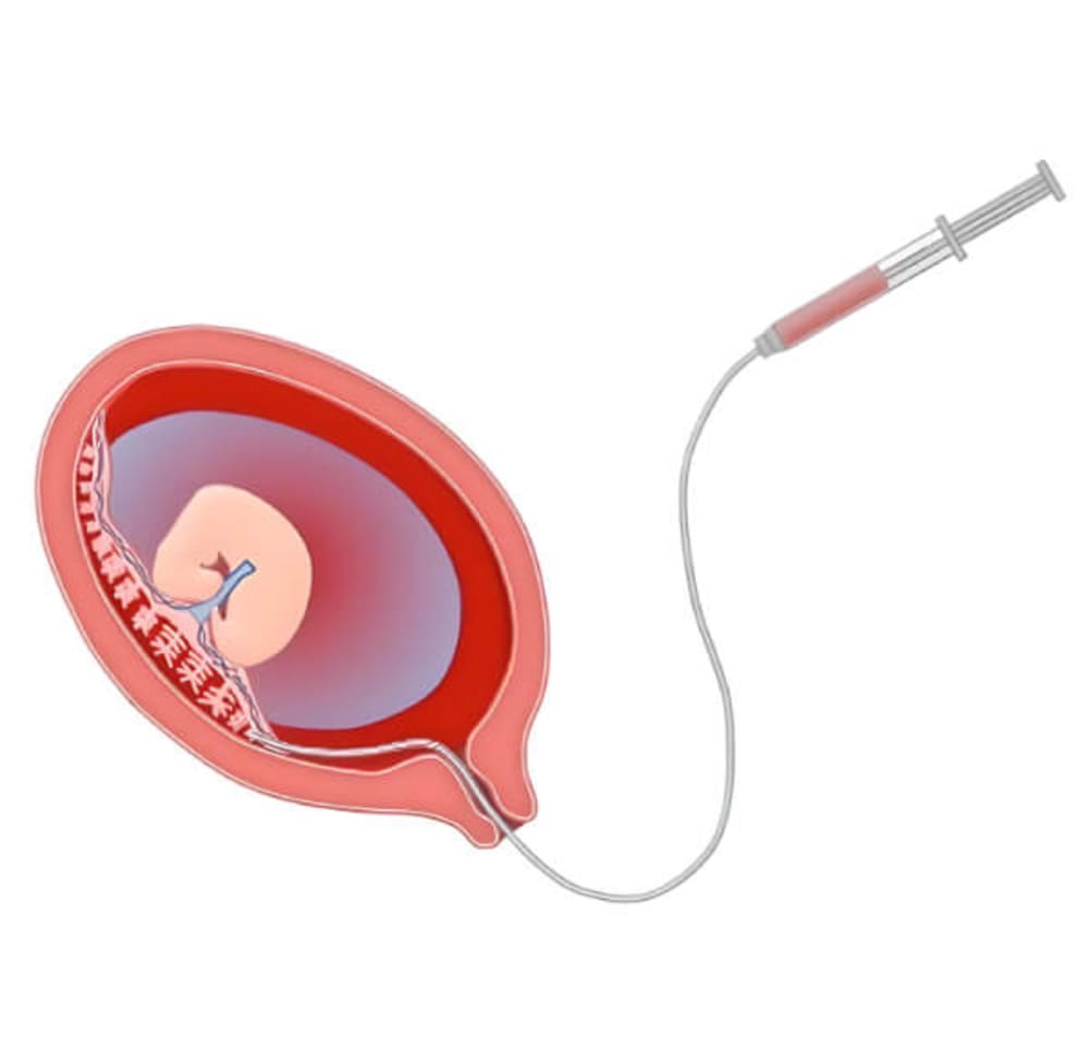 Testing chorionic villi tissue from placenta where it attaches to Uterine wall