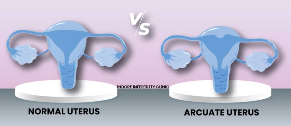 Arcuate Uterus: A mild indention at the top of the uterus. Generally considered a minor anomaly with minimal impact on pregnancy, but it can cause recurrent miscarriage.