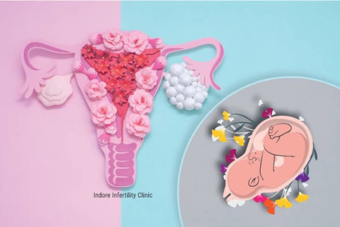PCOS – पीसीओएस और प्रेगनेंसी से जुड़ी सभी जरूरी बातें
