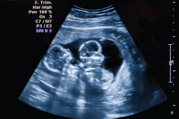 How Many Embryos to Transfer? | Elective Single Blastocyst Embryo Transfer