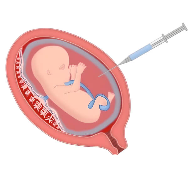 Amniocentesis – Testing of Fetal cells withdrawn from Amniotic Fluid