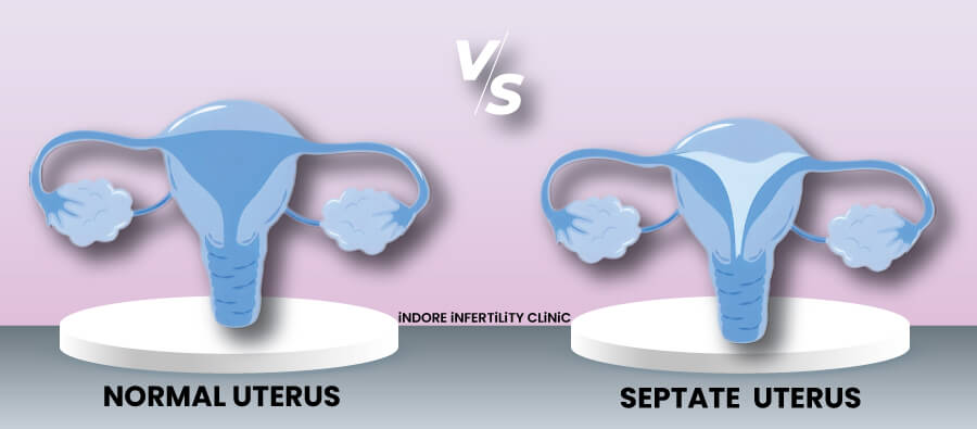 Septate Uterus: A septate uterus has a wall or partition (septum) within the uterine cavity, dividing it partially or completely. It may increase the risk of recurrent miscarriages or preterm birth (birth before 37 weeks of pregnancy).