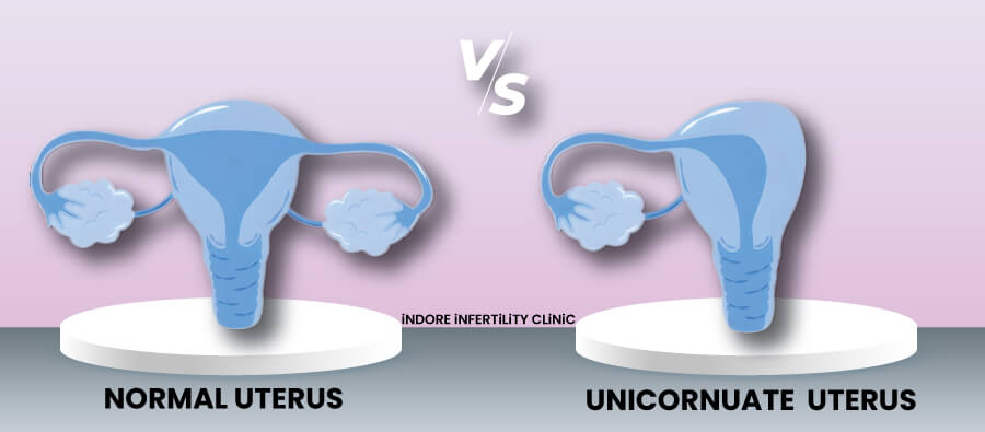 Unicornuate Uterus: The uterus is shaped like a single horn, with one side not fully developed. It has a higher risk of complications such as preterm birth and breech presentation (the baby is bottom first positioned in the uterus).
