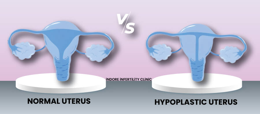 What is hypoplastic uterus?