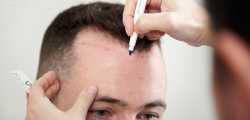 Trusting Hair Transplantation as a Solution for Hair Loss - Best Hair Transplantation Dubai