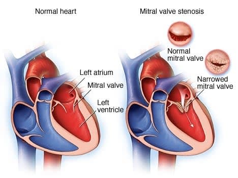 Estenosis mitral