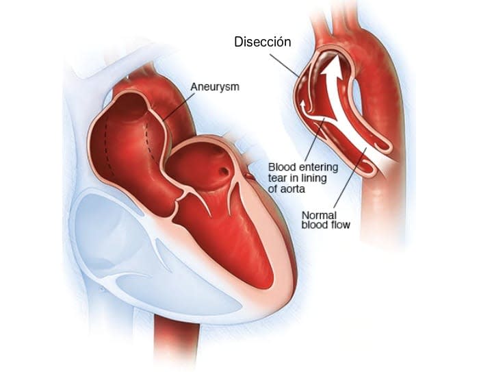 Disección de la Aorta Cirugía Cardiovascular Reparación sin Cirugía. Disección de la Aorta Cirugía Cardiovascular Reparación sin Cirugía.