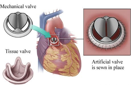 Cirugía Valvular Aórtica Corazón Abierto Tratamiento Especializado