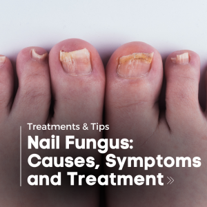 Nail Fungus Infections: Treatments & Causes