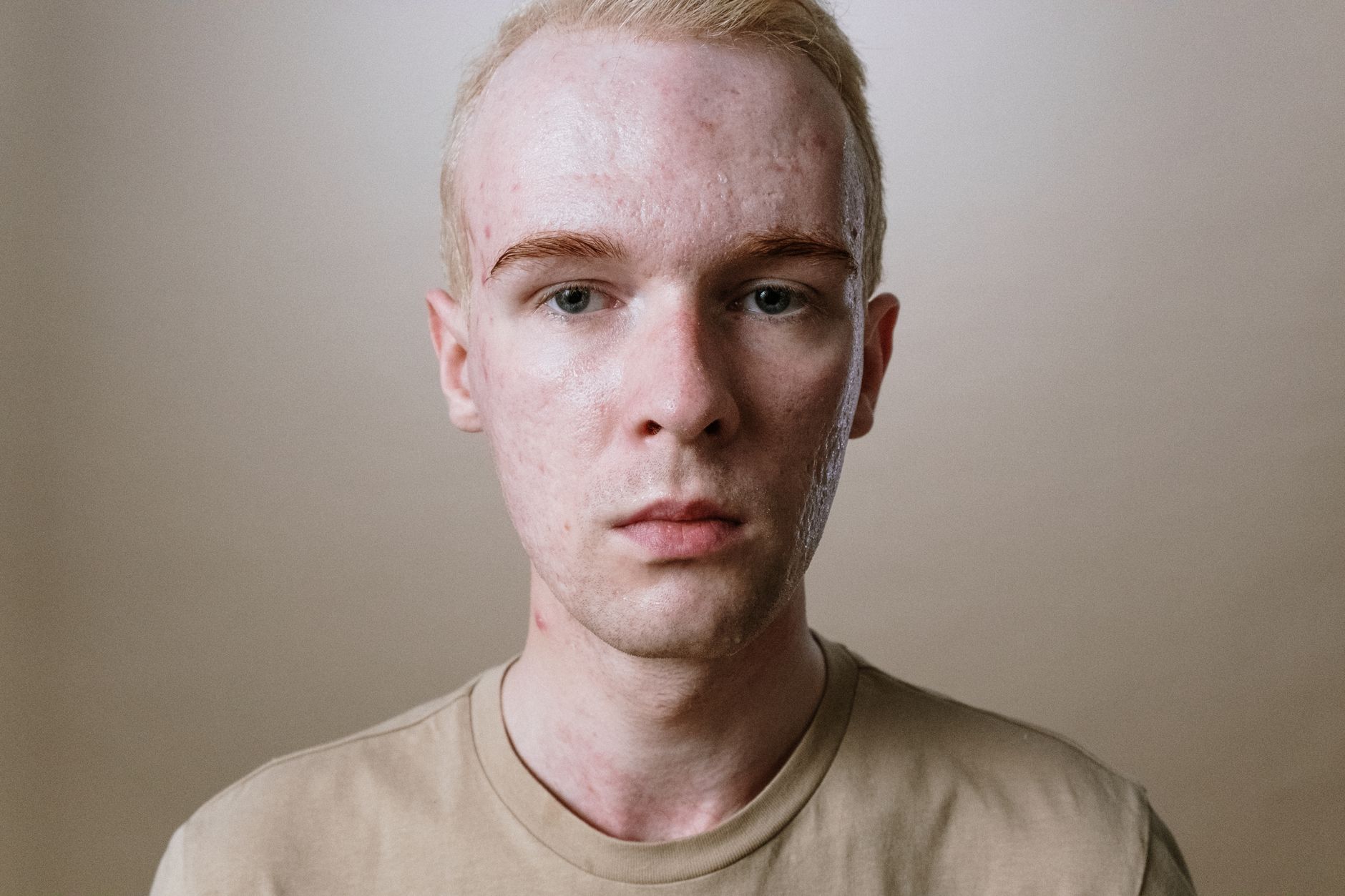 Know Your Enemy: Unveiling the Different Types of Acne in Acne-Prone Skin