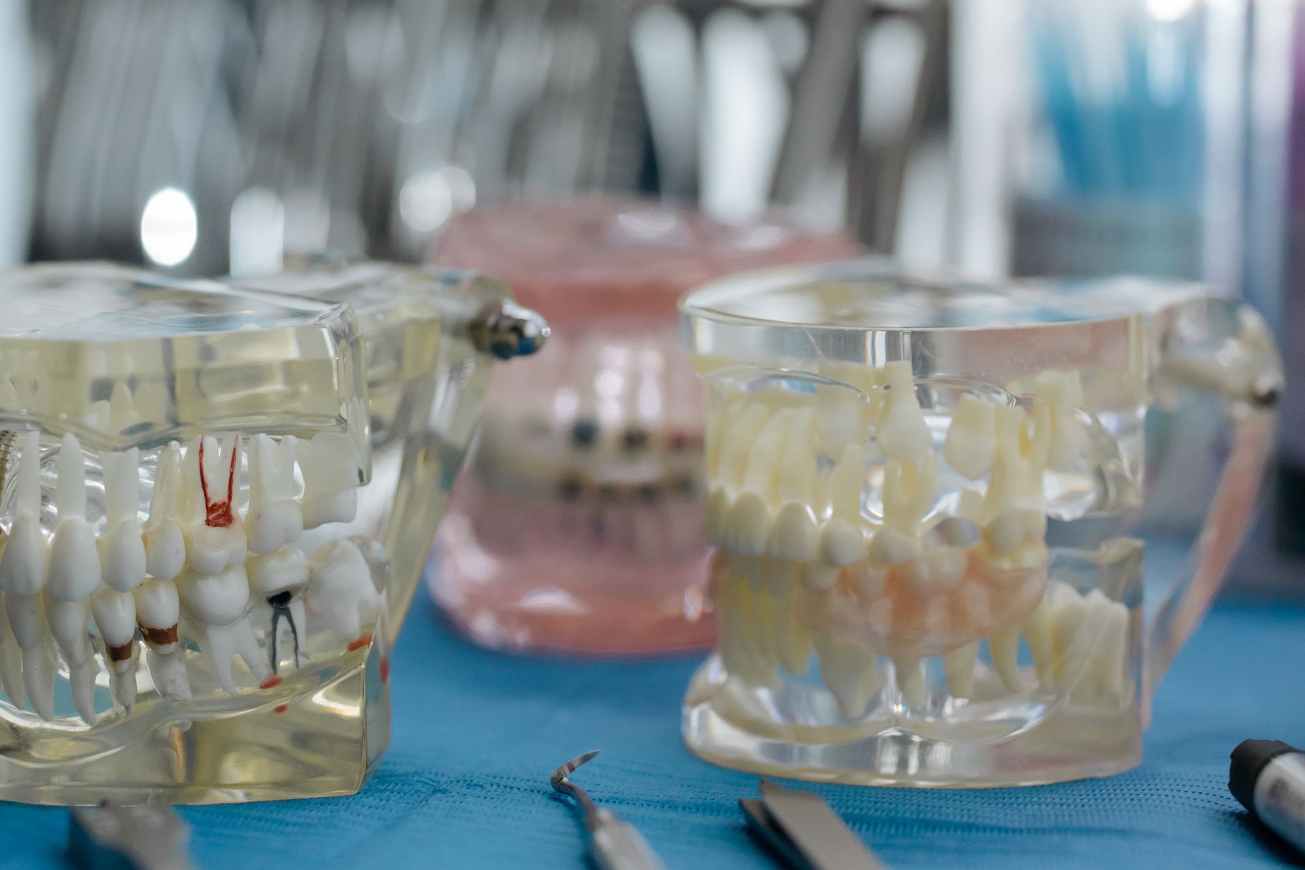 The Cost of Implant-Supported Dentures: What You Need to Know