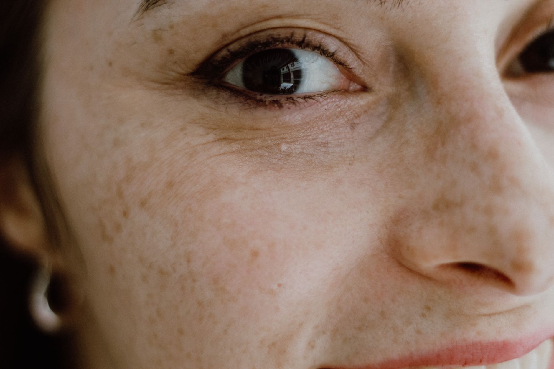5 Effective Natural Remedies For Facial Veins