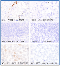 IHC FFPE
Staining of formalin fixed and paraffin embedded human tissues with the PASD1-2 2ALCC128 antibody. Testis shows strong nuclear expression in a subpopulation of spermatogonia near the basal membrane in testicular tubules. Tonsil, like most normal human tissues shows no PASD1 labelling. Nuclear PASD1 protein was detectable in the lung cancer cell line NCI-H1299. The MR12 mouse monoclonal antibody was used as a negative control to demonstrate the specificity of PASD1 staining.