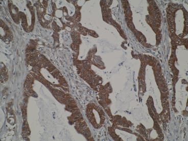 Immunohistochemistry was performed on formalin-fixed, paraffin-embedded tissue sections. Strong cytoplasmic positivity is observed in primary colorectal cancer using anti-CIDEA antibody [V62P1E3*B10]. Antigen retrieval step was required (microwave 10 min @ 950W in 0.01M sodium citrate buffer, pH 6.0).
